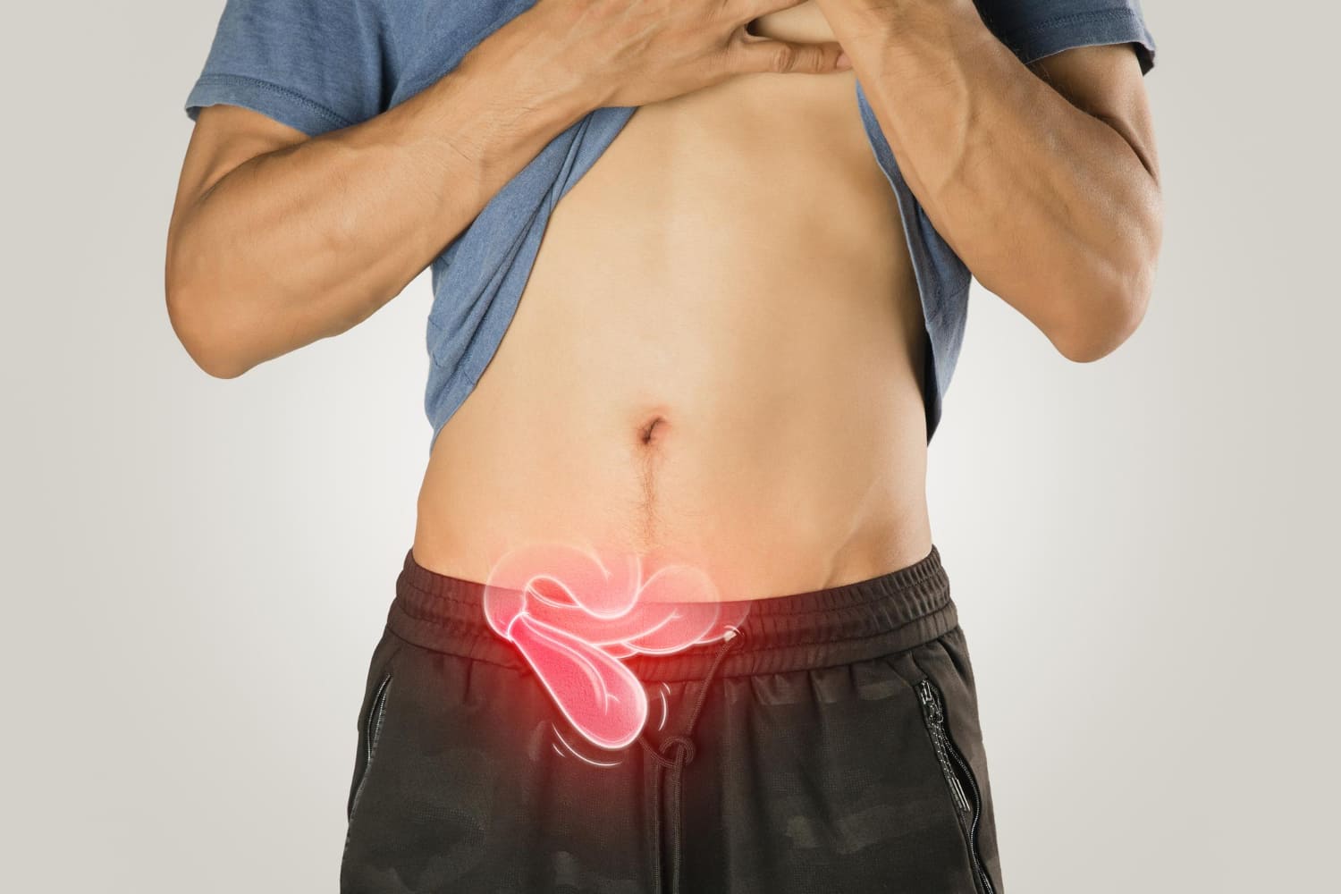 Hernias incisionales y de pared abdominal en Querétaro: Tratamientos especializados